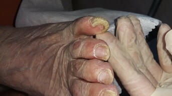 лечение грибка ногтей