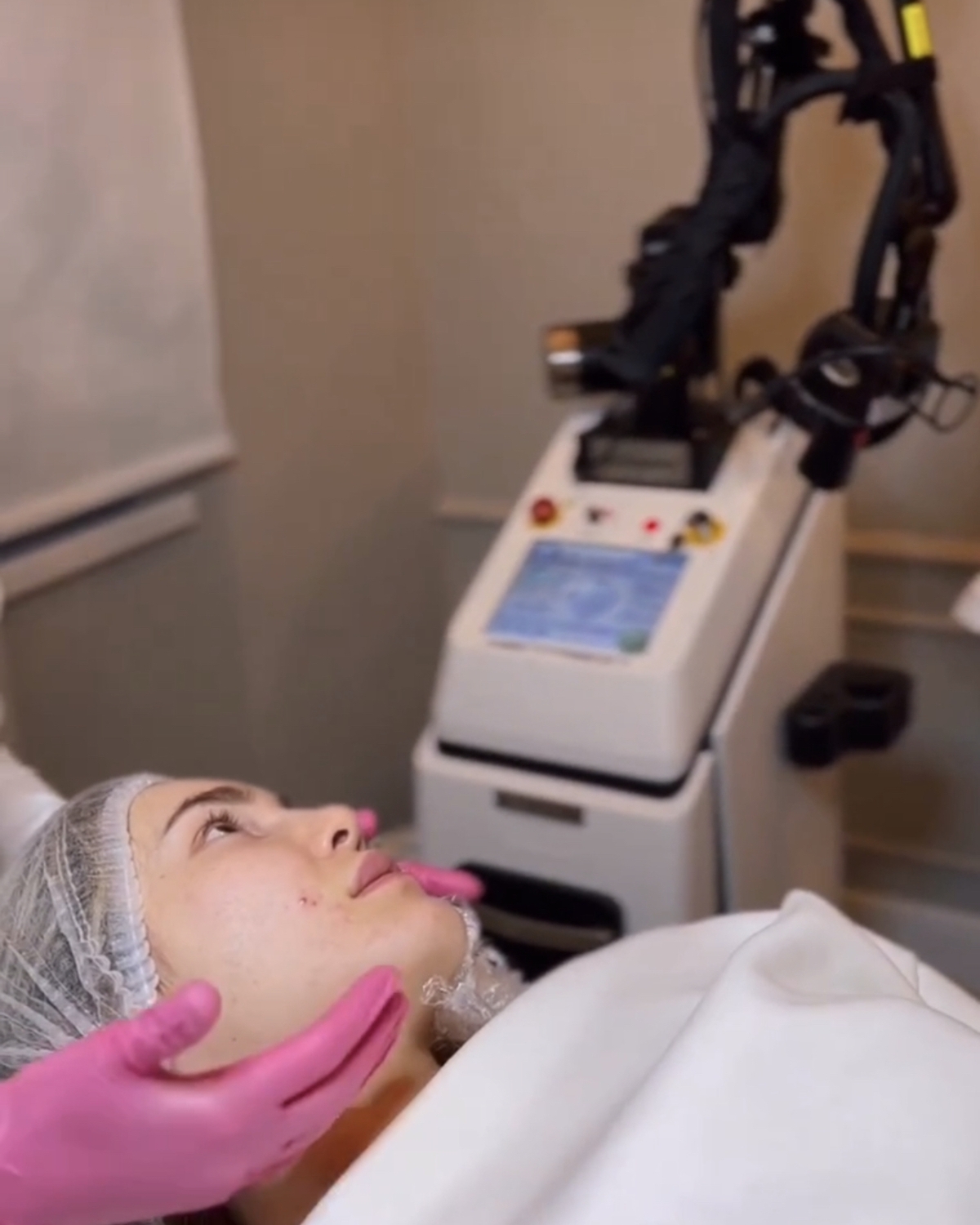 коррекция рубцов на аппарате омоложение лица на аппарате GRAND CELL RF коррекция рубцов на аппарате омоложение лица на аппарате GRAND CELL RF