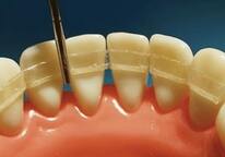 Шинирование подвижных зубов