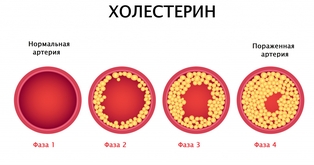 Как снизить уровень холестерина