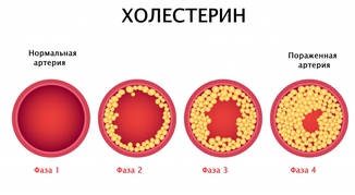 Рекомендации по снижению холестерина 
