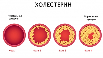 Рекомендации по снижению холестерина 