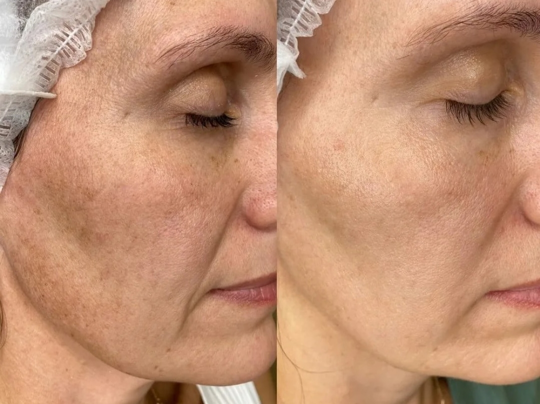 RF – ЛИФТИНГ на аппарате SCARLET S