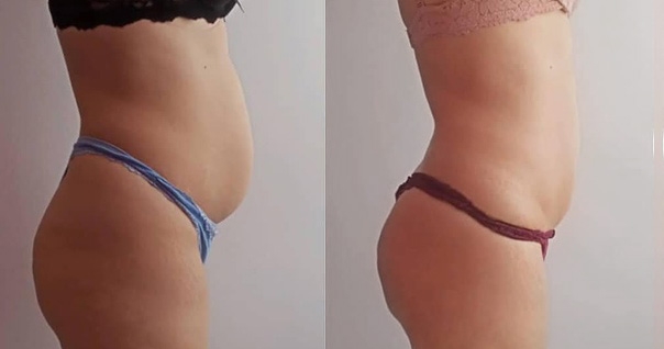 RSL-скульптурирование Beautylize