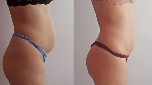 RSL-скульптурирование Beautylize