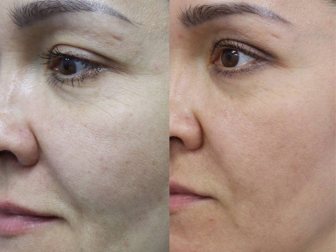 RF – ЛИФТИНГ на аппарате SCARLET S