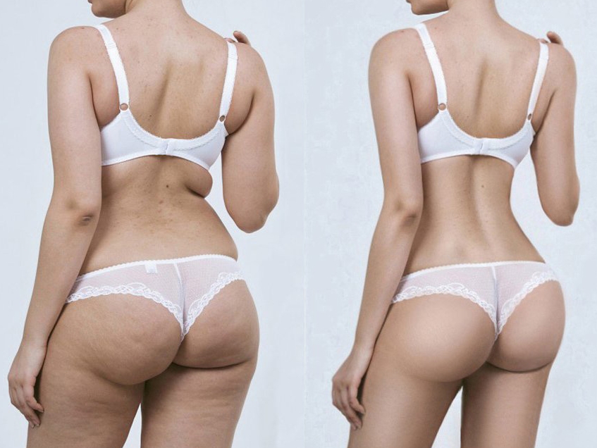 RSL-скульптурирование Beautylize