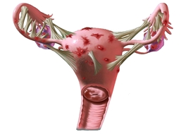Причины боли при эндометриозе