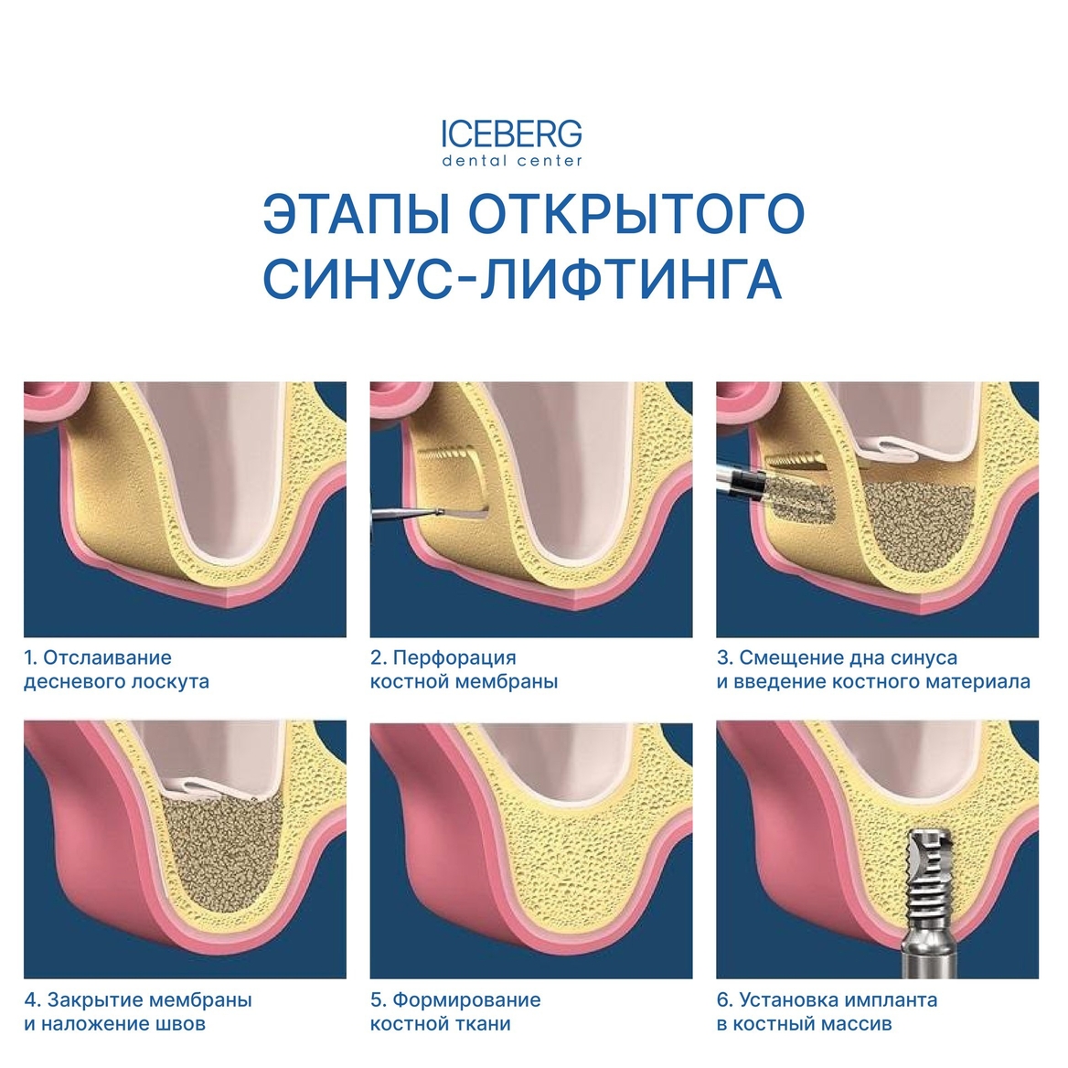 открытый синус лифтинг