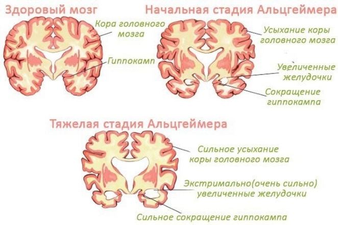 Болезнь Альцгеймера