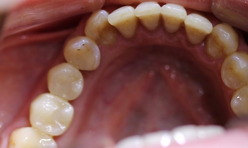 Имплантация двух жевательных зубов в Муроме стоматология Айсберг