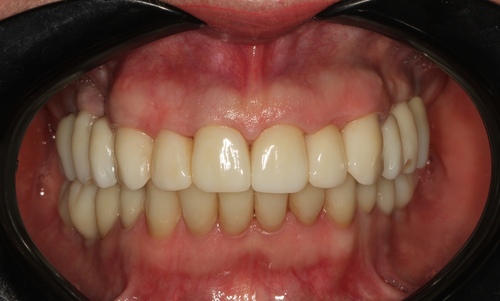 Восстановление жевательной функции с помощью имплантации, после удаления несосотоятельных зубов в Муромве стоматология Айсберг