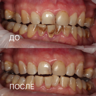 Проф гигиена зубов регулярная