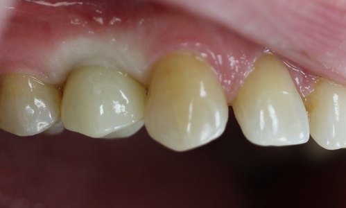 Имплантация одного зуба в Муроме