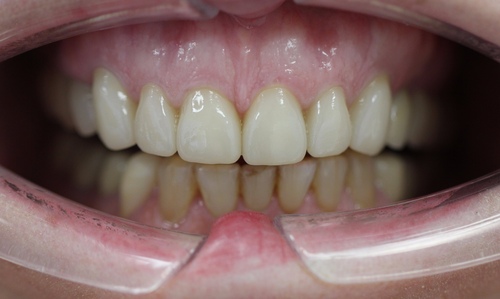 Восстановление зубов верхней чулюсти при помощи керомических коронок