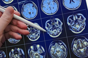 Виды приступов и принципы лечения приступов эпилепсии