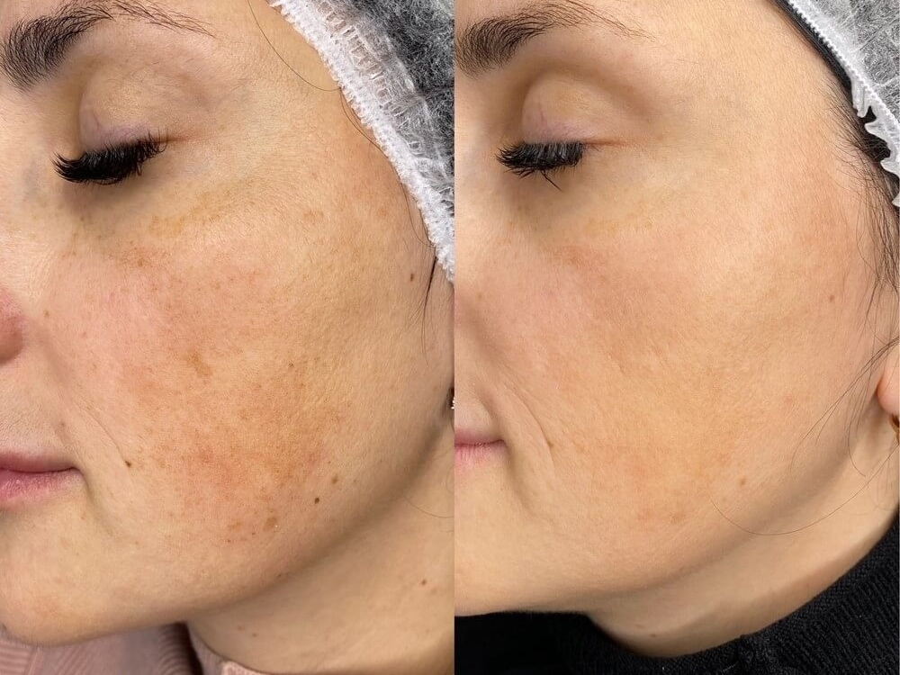 RF – ЛИФТИНГ на аппарате SCARLET S