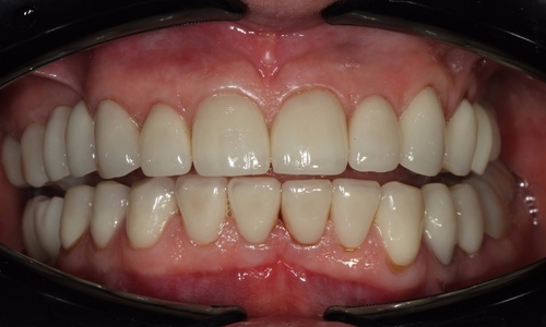 Восстановление улыбки керамическими коронками на своих зубах и имплантах в стоматологии Айсберг Муром