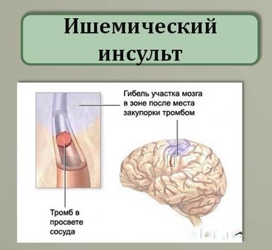 Ишемический инсульт возникает чаще при атеросклерозе. Причины ишемич инсульта. ишемический инсульт причины возникновения. предпосылки ишемического инсульта.