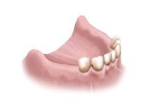 Частичное отсутствие зубов