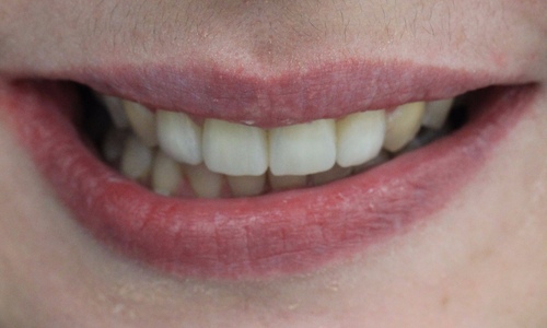 виниры, восстановление зубов , стоматология Айсберг Мурм