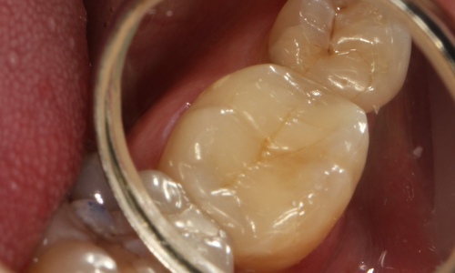Лечение кариеса и восстановление зуба в полную анатомию при помощи композитного материала. Стоматология Айсберг. Муром