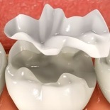 Несъёмные зубные протезы: вкладки