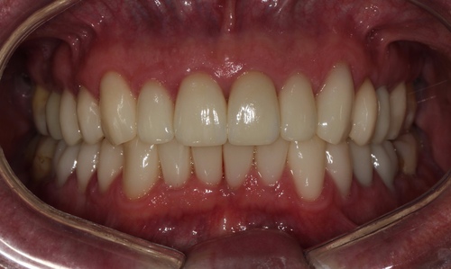 Восстановление улыбки керамическими коронками E.max на своих зубах стоматология Айсберг в Муроме
