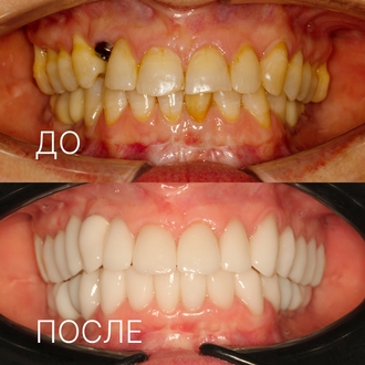 виниры