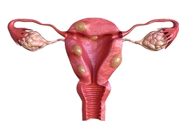 Причины боли при миоме