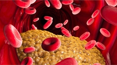 Как правильно сдавать анализ на холестерин?