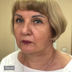 Лифтинг лица и шеи с блефаропластикой. Фото №4 после операции. Февраль 2023