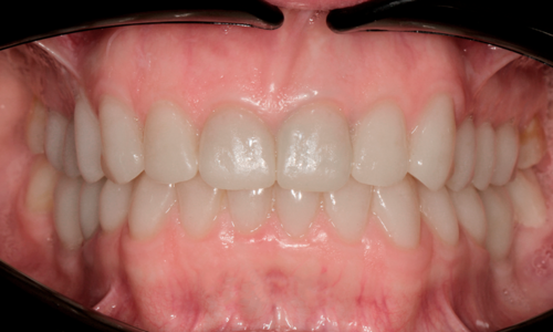 Восстановление улыбки керамическими коронками на своих зубах и двух жевательных зубов нижней челюсти на имплантах Стоматология Айсберг Мурм