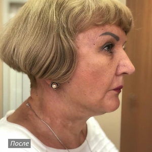 Лифтинг лица и шеи с блефаропластикой. Фото №3 после операции. Февраль 2023