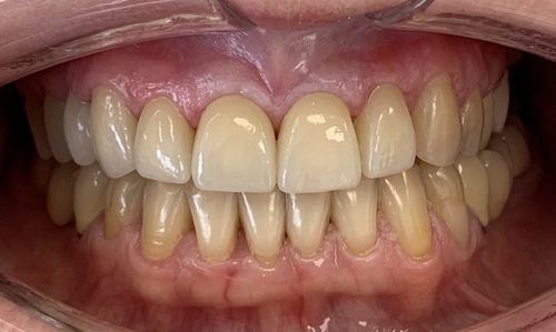 Верхний зубной ряд восстановлен с помощью керамических коронок . Стоматология Айсберг Муром