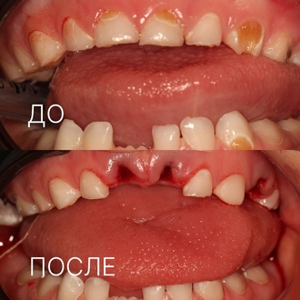 Удаление молочного зуба в Мурме
