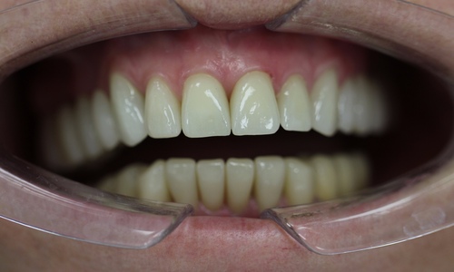 Выполнена комплексная работа по восстановлению всех зубов в стоматологии Айсберг Муром