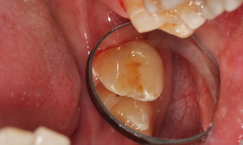 Лечение кариеса и восстановление зуба в полную анатомию при помощи композитного материала. Стоматология Айсберг. Муром