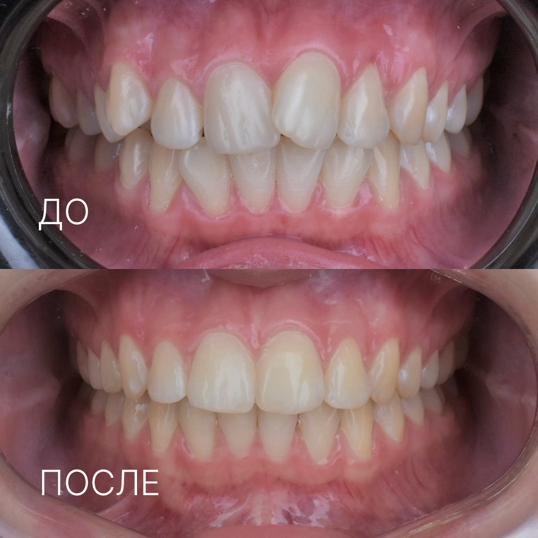 исправление прикуса в Муроме