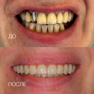 Установка импланта Neodent