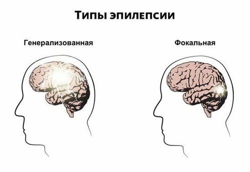 Типы эпилепсии