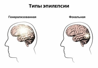 Типы эпилепсии