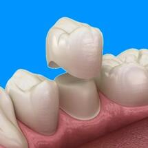 Несъёмные зубные протезы: коронки