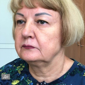 Лифтинг лица и шеи с блефаропластикой. Фото №4 до операции. Февраль 2023