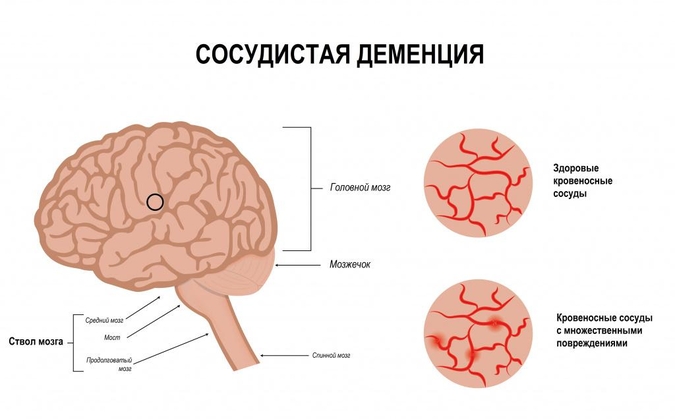 Фото Сосудистой деменции