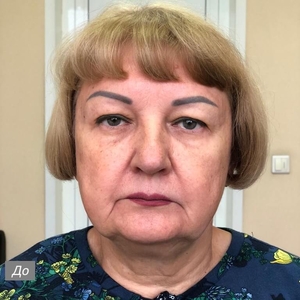 Лифтинг лица и шеи с блефаропластикой. Фото №2 до операции. Февраль 2023