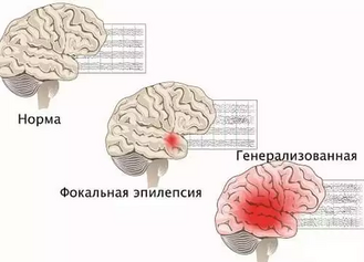 Фокальные и генерализованные приступы эпилепсии
