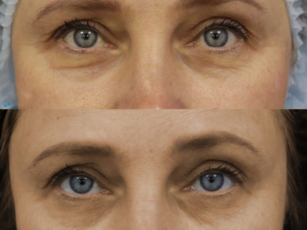 RF – ЛИФТИНГ на аппарате SCARLET S