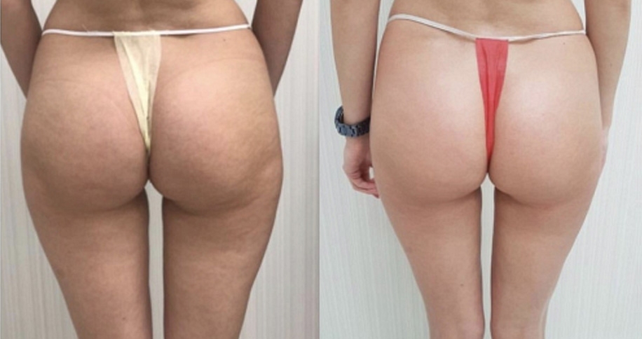 RSL-скульптурирование Beautylize