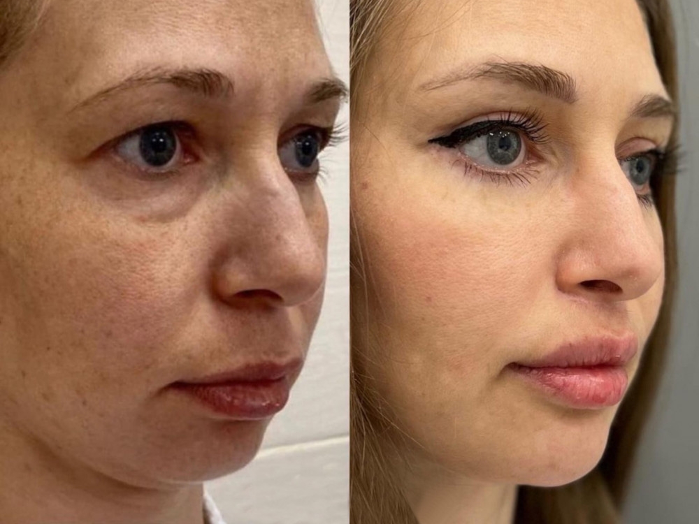 RF – ЛИФТИНГ на аппарате SCARLET S